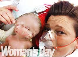 澳洲、印度驚見雙面女嬰